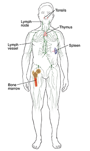 What Is Non-Hodgkin Lymphoma