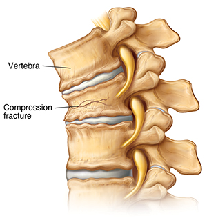 Back Fracture (Compression Fracture)