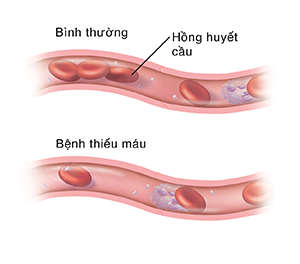 Mặt cắt của mạch máu với lượng hồng huyết cầu bình thường. Bên dưới là mặt cắt khác của mạch máu cho thấy số lượng hồng huyết cầu ít hơn rất nhiều do bệnh thiếu máu.